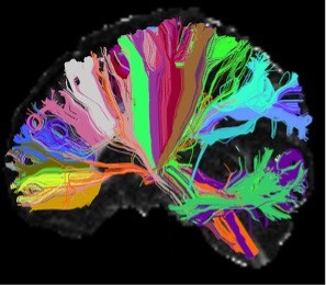 Connectom brain pathways -- A brain showing diverse coloured pathways unique to each person